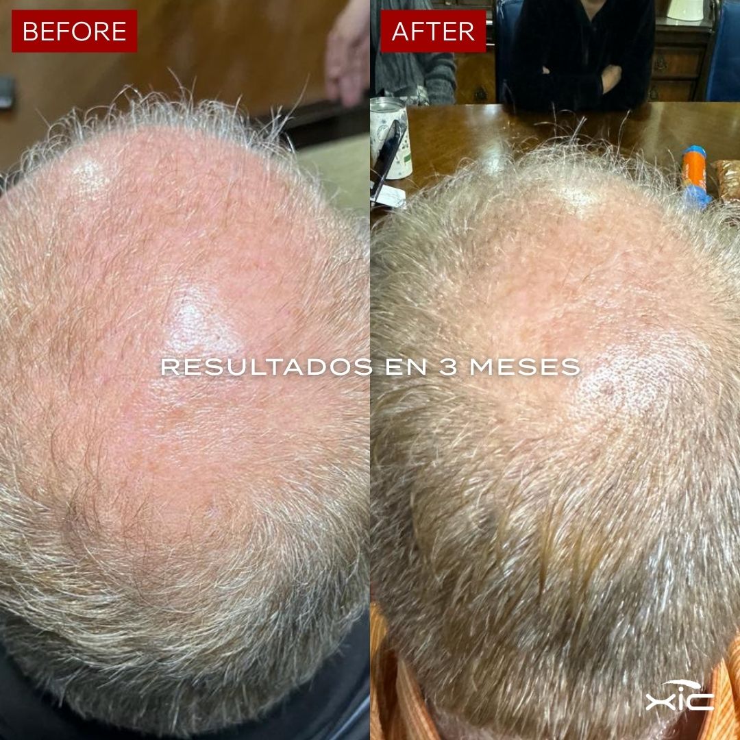 3 FOLiX - Suplemento para el Crecimiento del Cabello