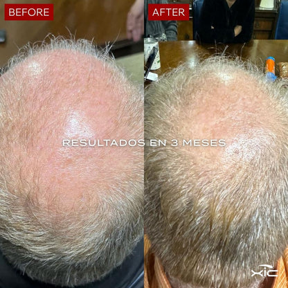 3 FOLiX - Suplemento para el Crecimiento del Cabello