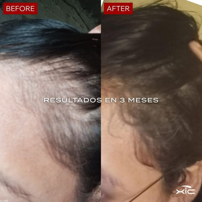 3 FOLiX - Suplemento para el Crecimiento del Cabello