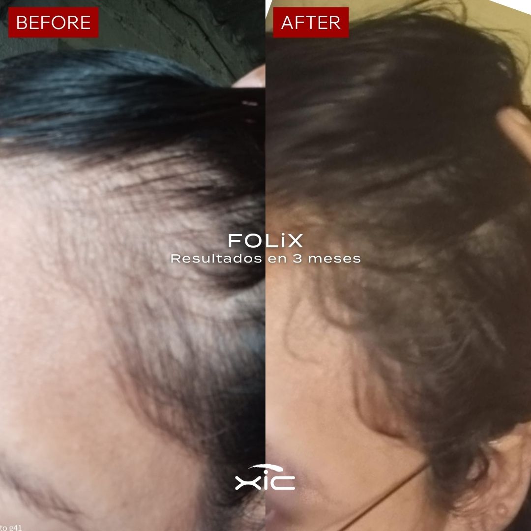 3 FOLiX - Suplemento para el Crecimiento del Cabello