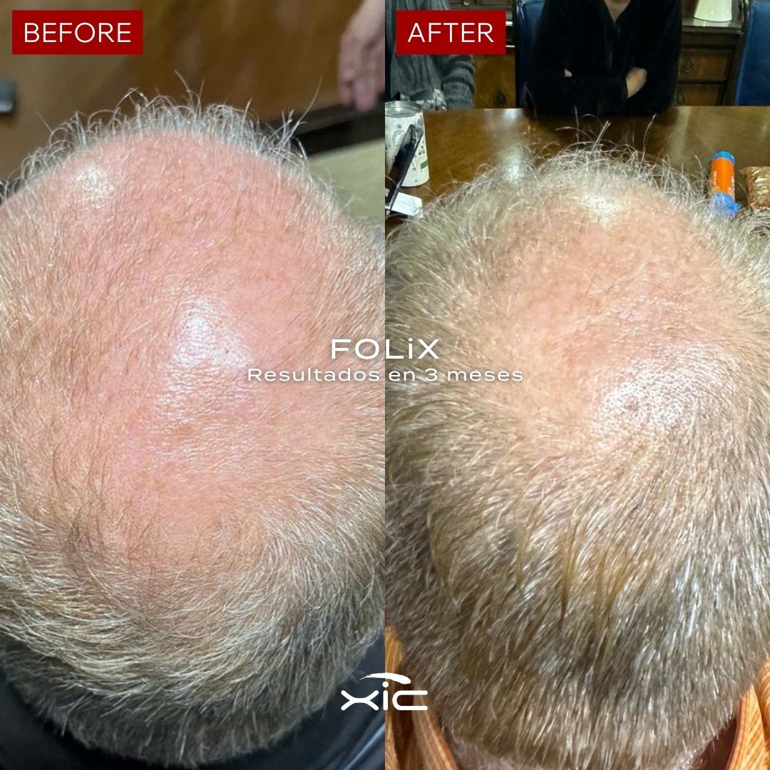 3 FOLiX - Suplemento para el Crecimiento del Cabello